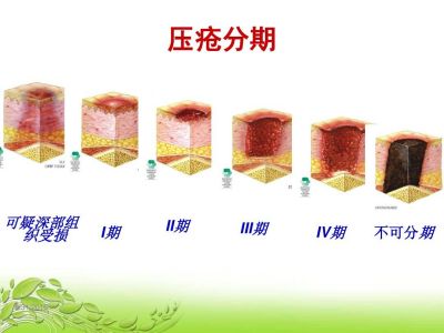 压疮最新分期解析，探索压疮新分期与2024年最新分期解读